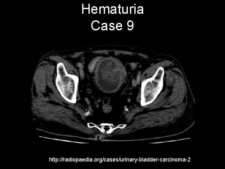 Hematuria Case 9 http: //radiopaedia. org/cases/urinary-bladder-carcinoma-2 