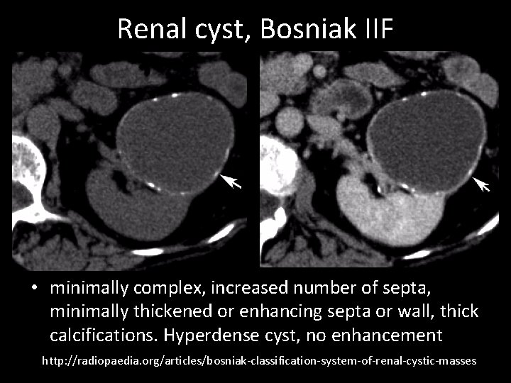 Renal cyst, Bosniak IIF • minimally complex, increased number of septa, minimally thickened or