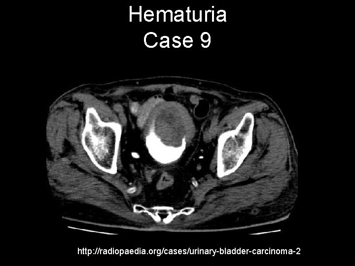 Hematuria Case 9 http: //radiopaedia. org/cases/urinary-bladder-carcinoma-2 