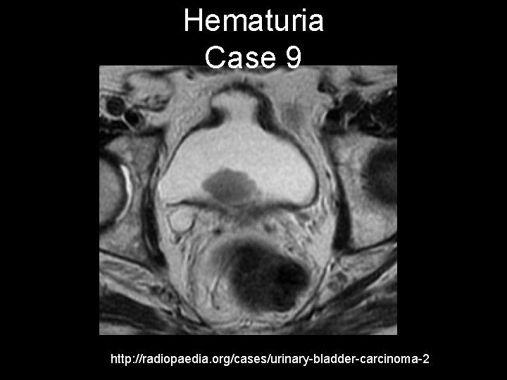 Hematuria Case 9 http: //radiopaedia. org/cases/urinary-bladder-carcinoma-2 