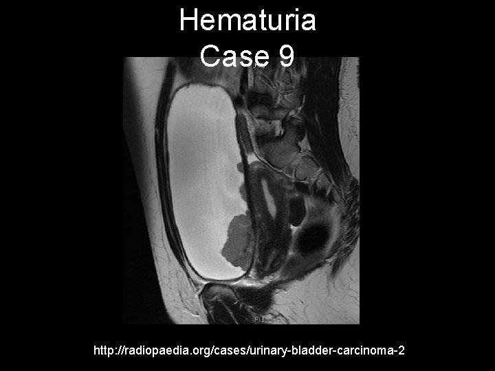 Hematuria Case 9 http: //radiopaedia. org/cases/urinary-bladder-carcinoma-2 