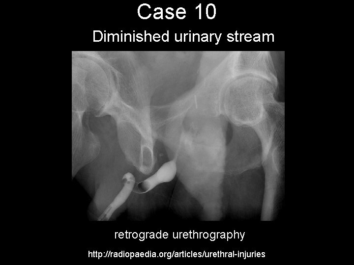 Case 10 Diminished urinary stream retrograde urethrography http: //radiopaedia. org/articles/urethral-injuries 