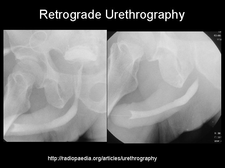 Retrograde Urethrography http: //radiopaedia. org/articles/urethrography 