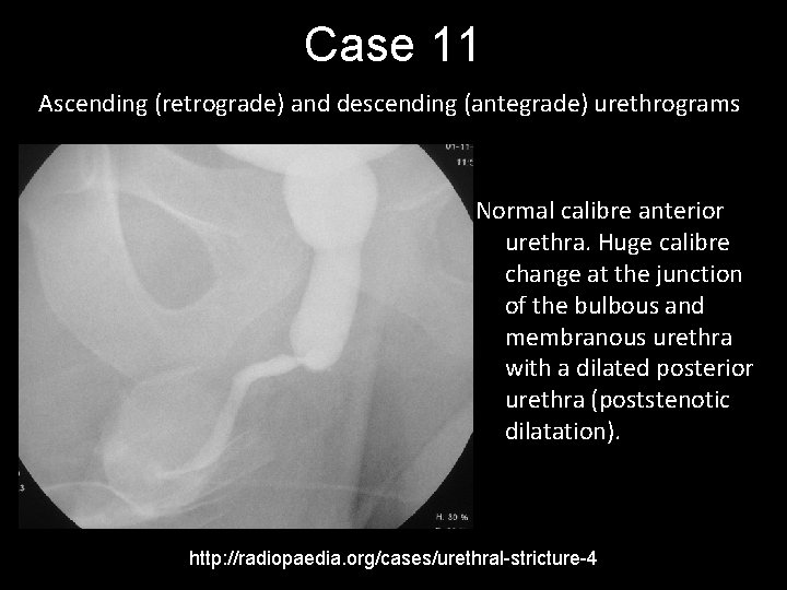 Case 11 Ascending (retrograde) and descending (antegrade) urethrograms Normal calibre anterior urethra. Huge calibre