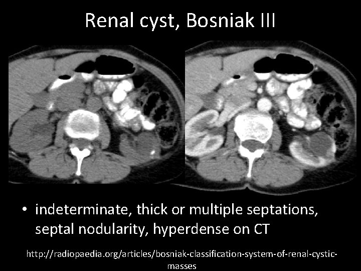 Renal cyst, Bosniak III • indeterminate, thick or multiple septations, septal nodularity, hyperdense on