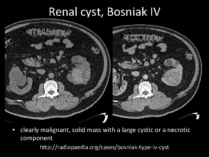 Renal cyst, Bosniak IV • clearly malignant, solid mass with a large cystic or