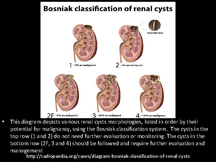  • This diagram depicts various renal cysts morphologies, listed in order by their