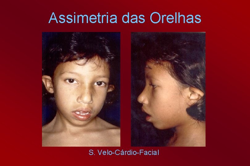 Assimetria das Orelhas S. Velo-Cárdio-Facial 