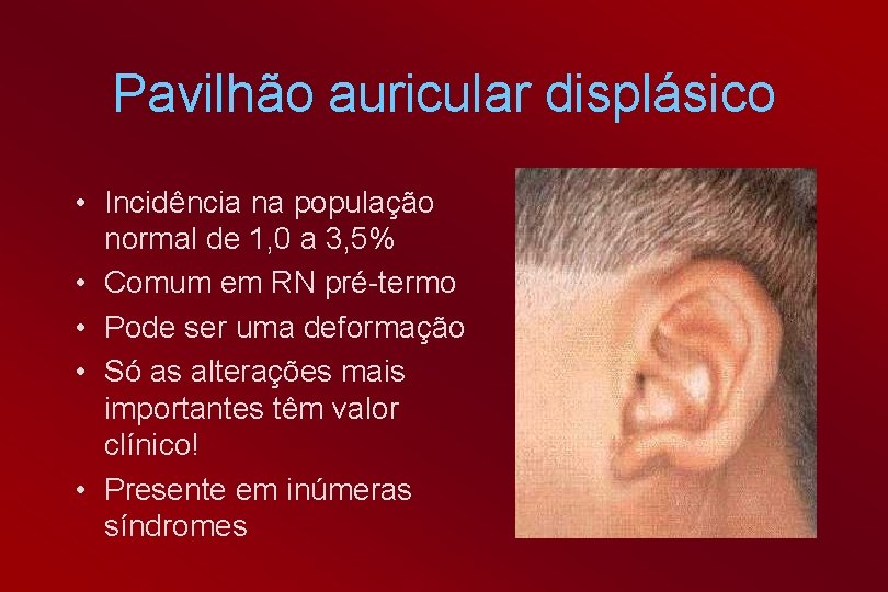 Pavilhão auricular displásico • Incidência na população normal de 1, 0 a 3, 5%