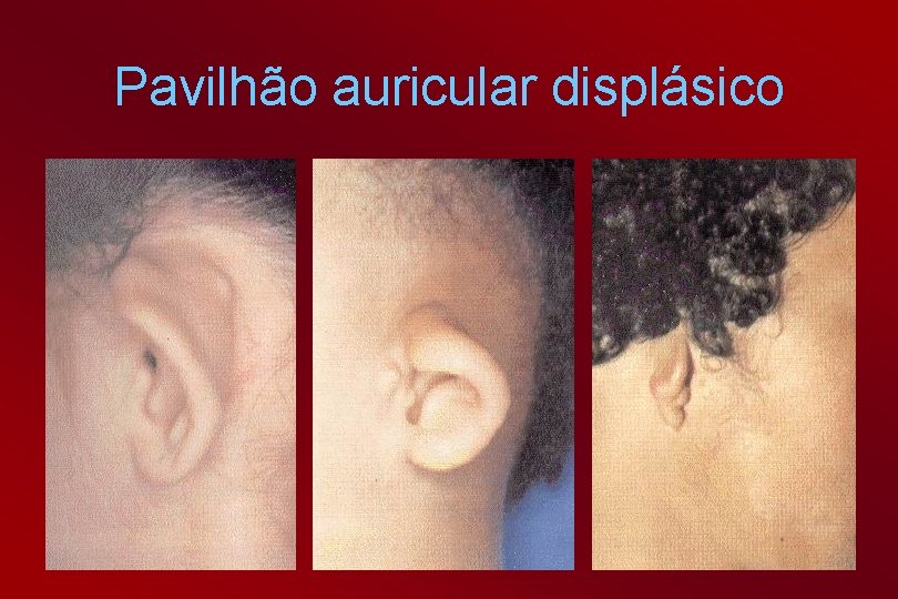 Pavilhão auricular displásico 