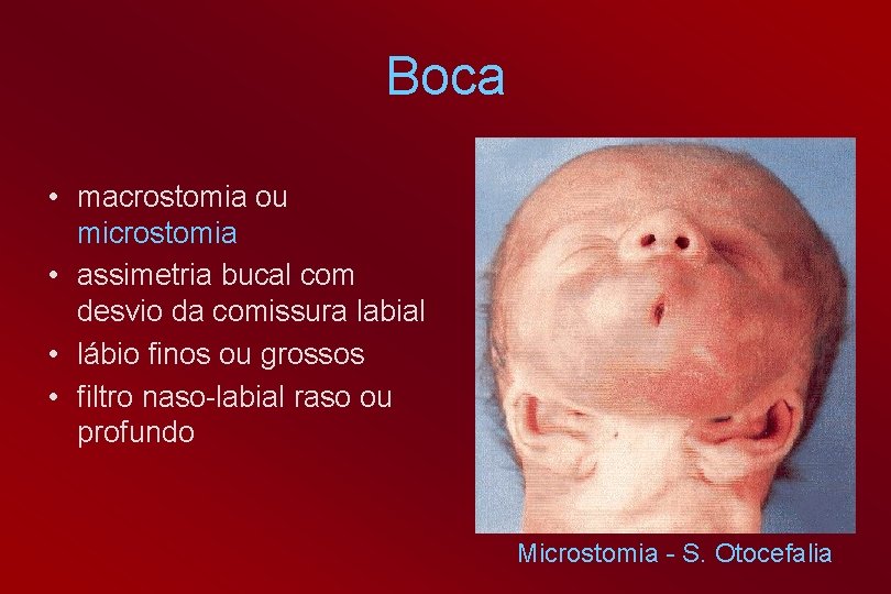 Boca • macrostomia ou microstomia • assimetria bucal com desvio da comissura labial •