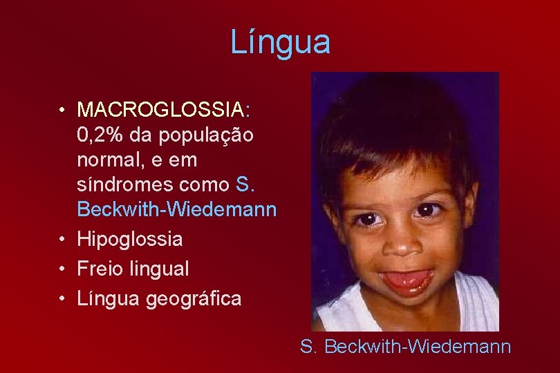 Língua • MACROGLOSSIA: 0, 2% da população normal, e em síndromes como S. Beckwith-Wiedemann