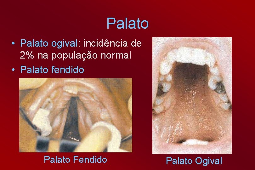 Palato • Palato ogival: incidência de 2% na população normal • Palato fendido Palato