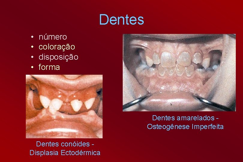 Dentes • • número coloração disposição forma Dentes amarelados Osteogênese Imperfeita Dentes conóides Displasia