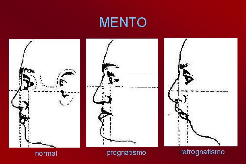 MENTO normal prognatismo retrognatismo 