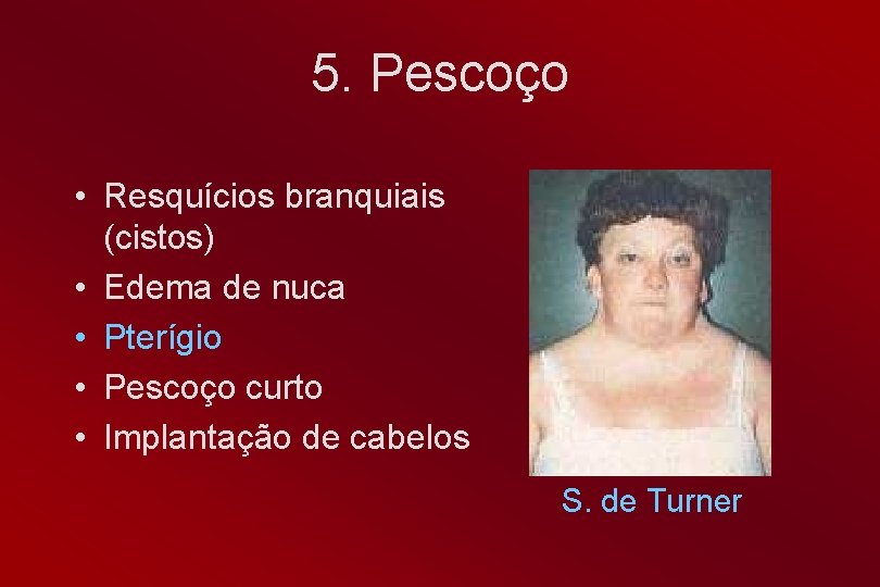 5. Pescoço • Resquícios branquiais (cistos) • Edema de nuca • Pterígio • Pescoço