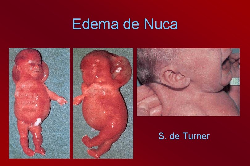 Edema de Nuca S. de Turner 