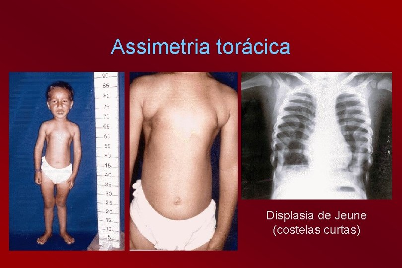 Assimetria torácica Displasia de Jeune (costelas curtas) 