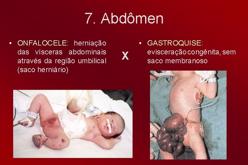 7. Abdômen • ONFALOCELE: herniação das vísceras abdominais através da região umbilical (saco herniário)