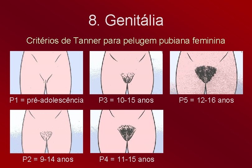 8. Genitália Critérios de Tanner para pelugem pubiana feminina P 1 = pré-adolescência P