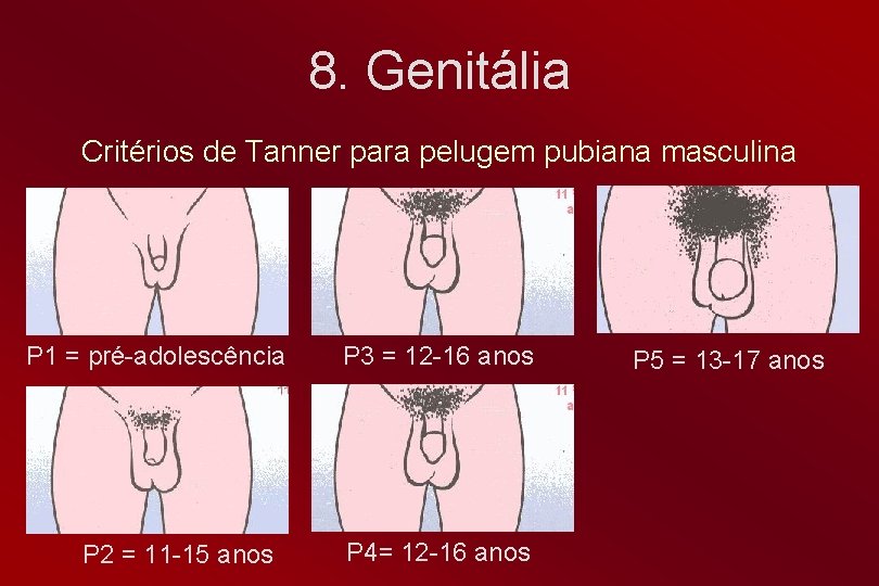 8. Genitália Critérios de Tanner para pelugem pubiana masculina P 1 = pré-adolescência P