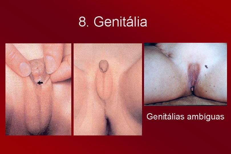 8. Genitálias ambíguas 