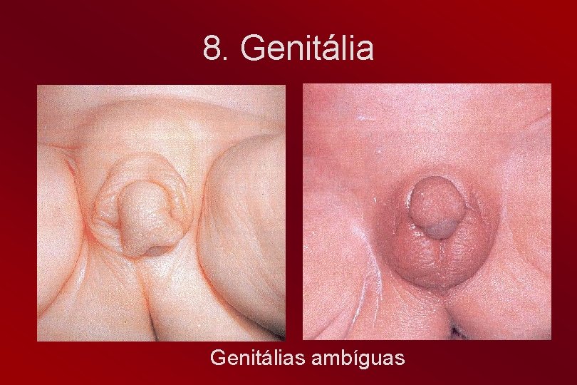 8. Genitálias ambíguas 