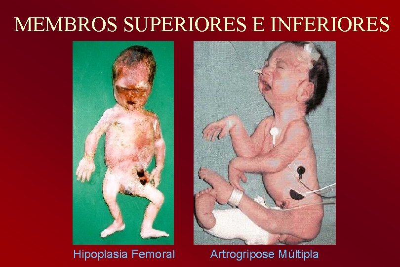 MEMBROS SUPERIORES E INFERIORES Hipoplasia Femoral Artrogripose Múltipla 