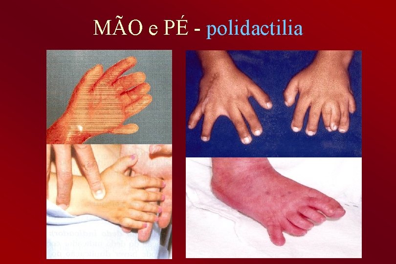 MÃO e PÉ - polidactilia 