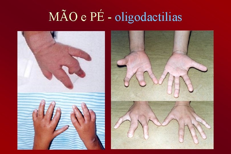 MÃO e PÉ - oligodactilias 