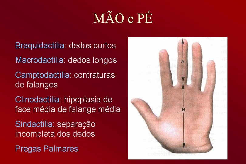 MÃO e PÉ Braquidactilia: dedos curtos Macrodactilia: dedos longos Camptodactilia: contraturas de falanges Clinodactilia: