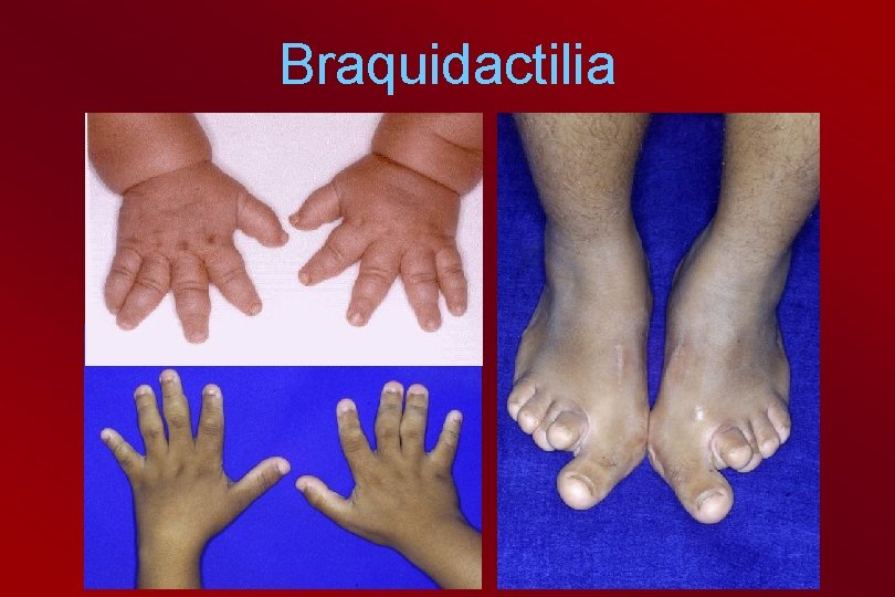 Braquidactilia 