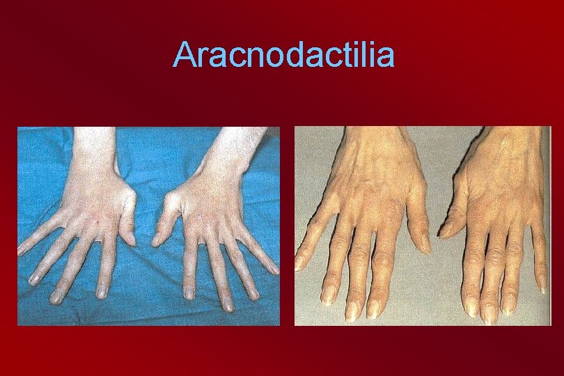 Aracnodactilia 