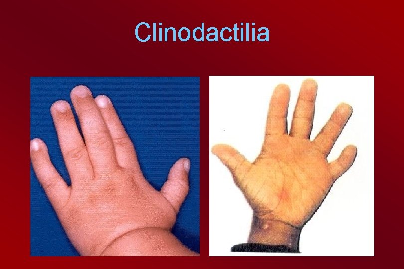 Clinodactilia 