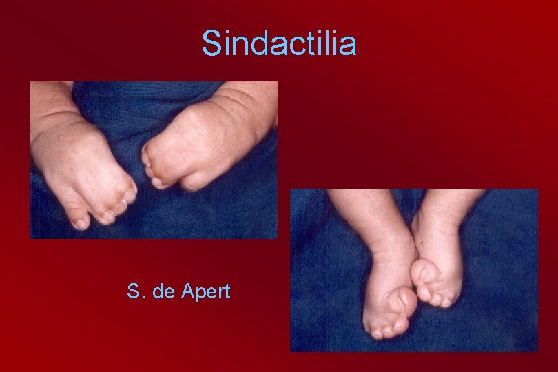 Sindactilia S. de Apert 