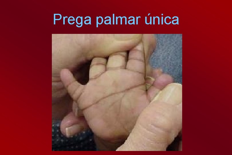 Prega palmar única 