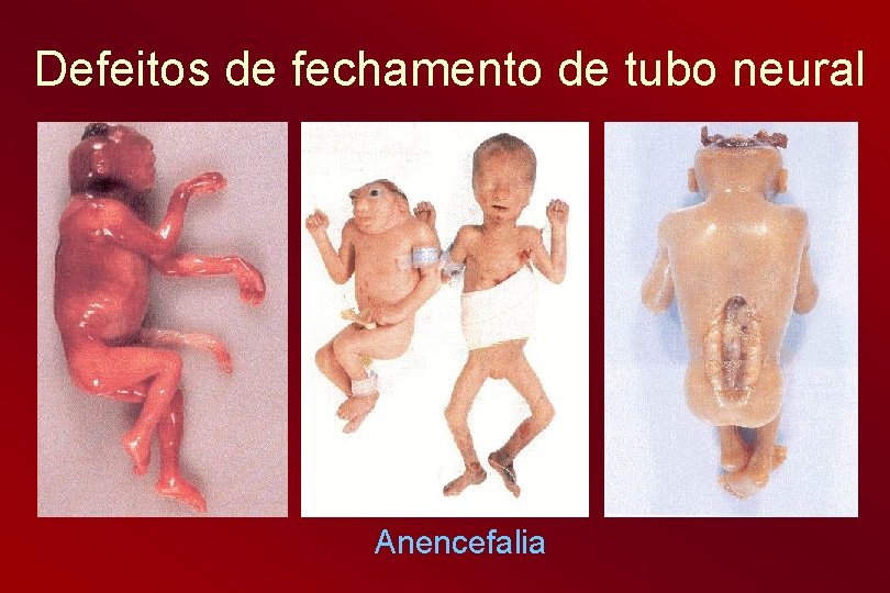 Defeitos de fechamento de tubo neural Anencefalia 