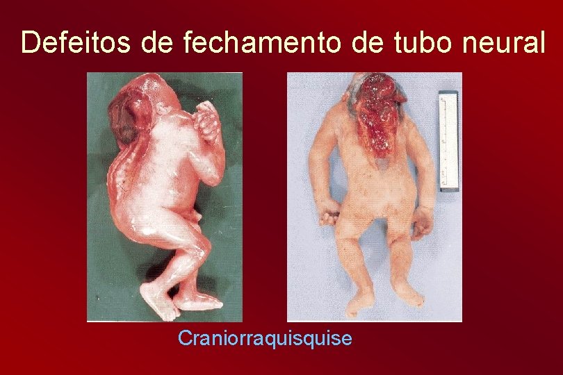 Defeitos de fechamento de tubo neural Craniorraquise 