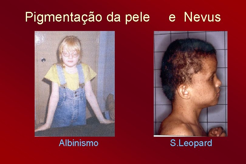Pigmentação da pele Albinismo e Nevus S. Leopard 