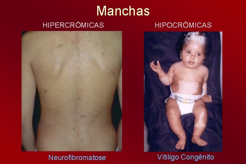 Manchas HIPERCRÔMICAS Neurofibromatose HIPOCRÔMICAS Vitiligo Congênito 