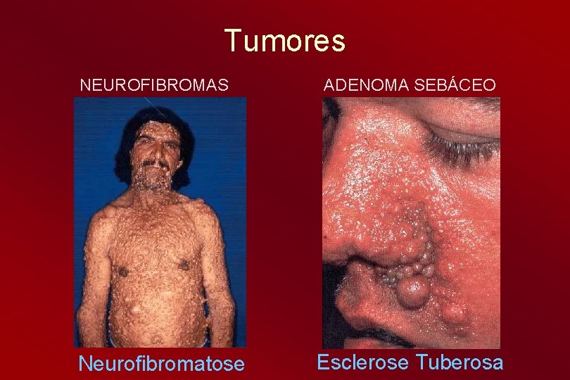 Tumores NEUROFIBROMAS Neurofibromatose ADENOMA SEBÁCEO Esclerose Tuberosa 