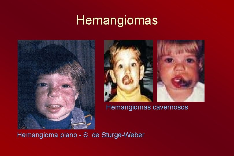 Hemangiomas cavernosos Hemangioma plano - S. de Sturge-Weber 