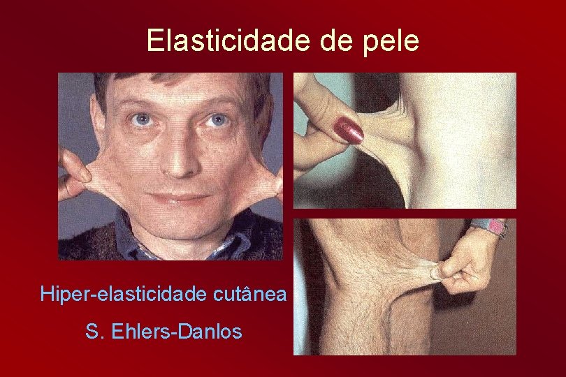 Elasticidade de pele Hiper-elasticidade cutânea S. Ehlers-Danlos 