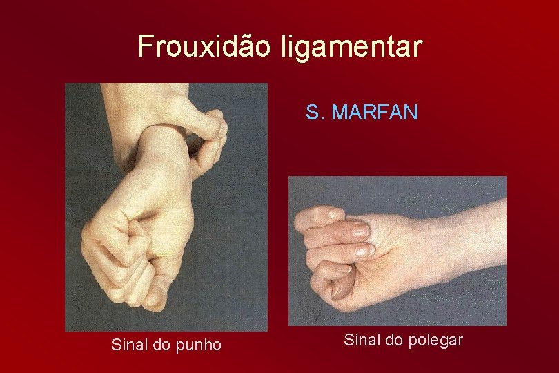 Frouxidão ligamentar S. MARFAN Sinal do punho Sinal do polegar 