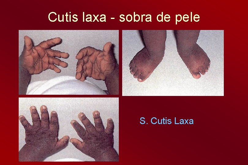 Cutis laxa - sobra de pele S. Cutis Laxa 