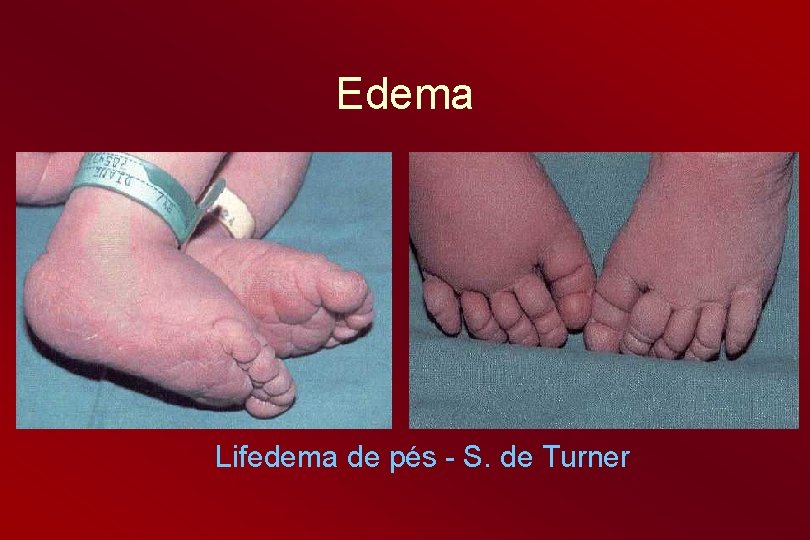 Edema Lifedema de pés - S. de Turner 