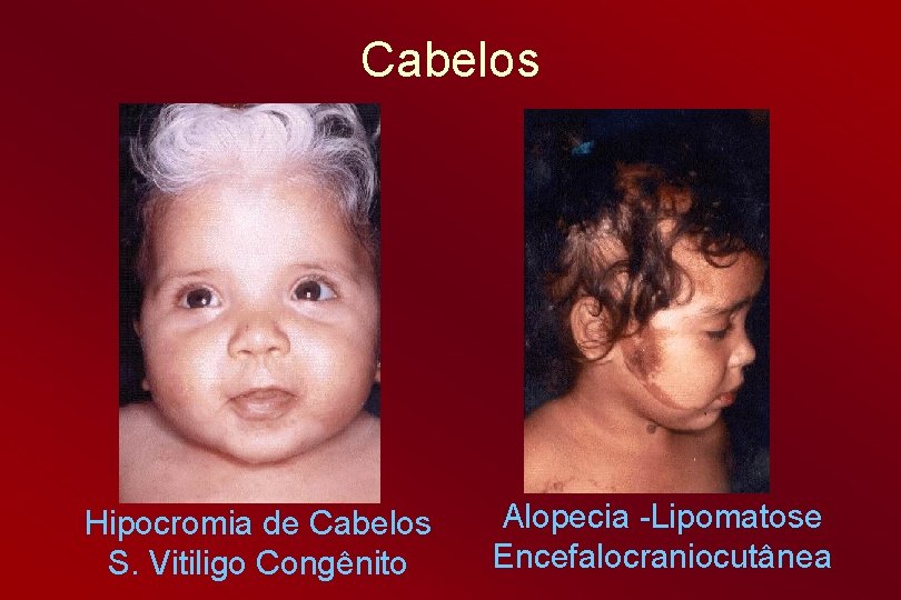 Cabelos Hipocromia de Cabelos S. Vitiligo Congênito Alopecia -Lipomatose Encefalocraniocutânea 