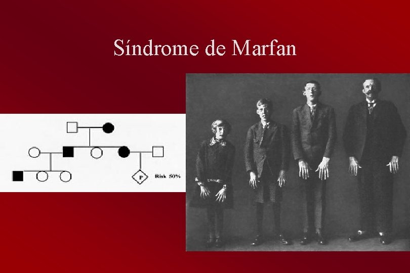 Síndrome de Marfan 