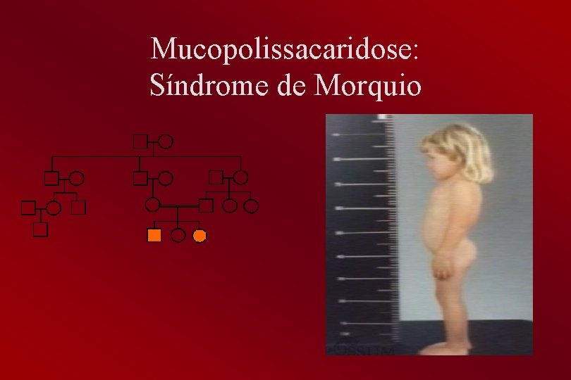 Mucopolissacaridose: Síndrome de Morquio 
