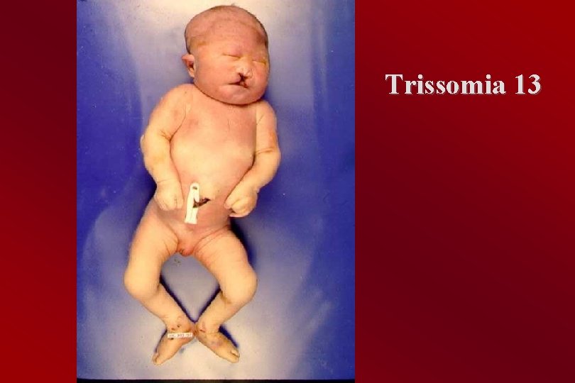 Trissomia 13 